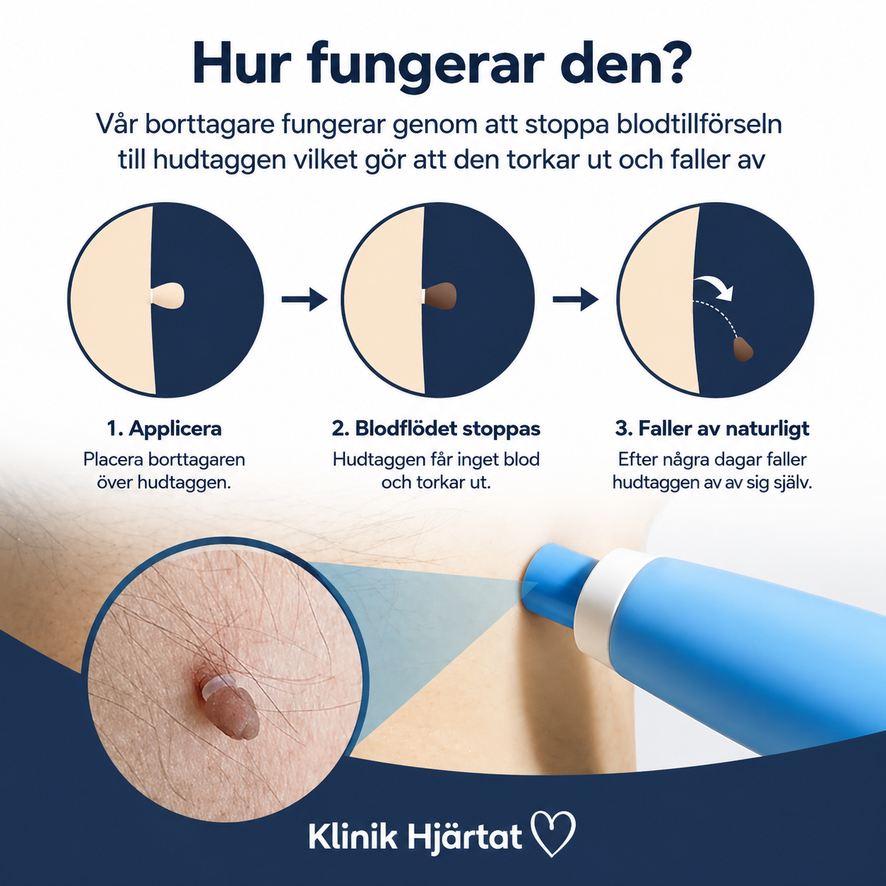 Hudfliksborttagare