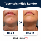 Hudfliksborttagare