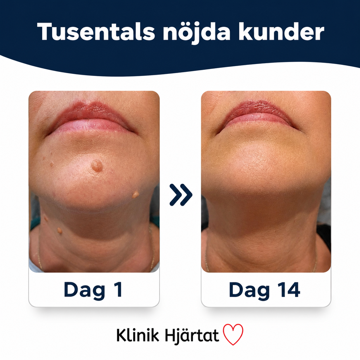 Hudfliksborttagare